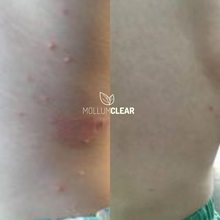 Load image into Gallery viewer, Extra Strength Mollumclear Bundle